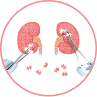 Böbrek Hastalarında Tıbbi Beslenme Tedavisi